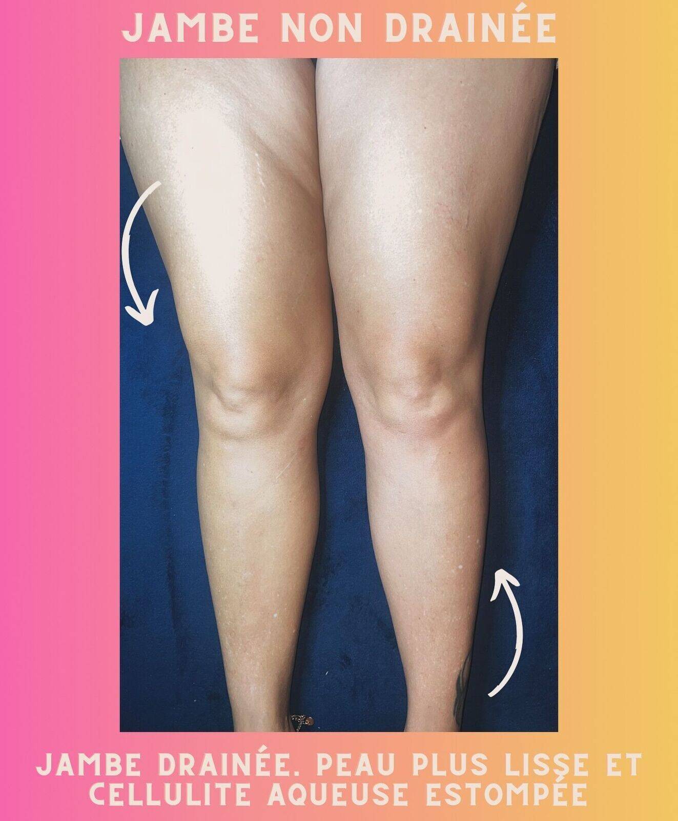 Le forfait drainage lymphatique jambes