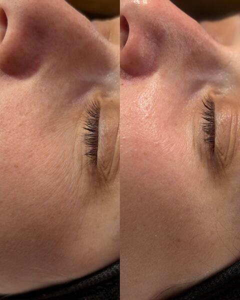 Résultat soin Hydrofacial 
