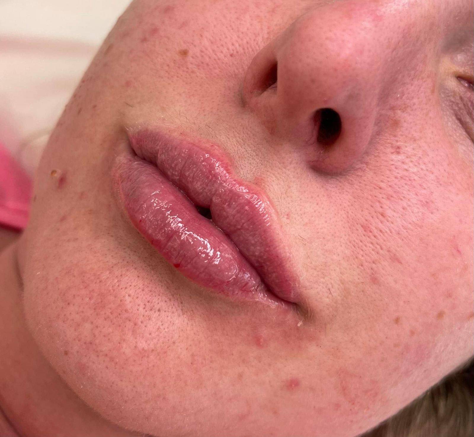 1.1ml Lip Enhancement 