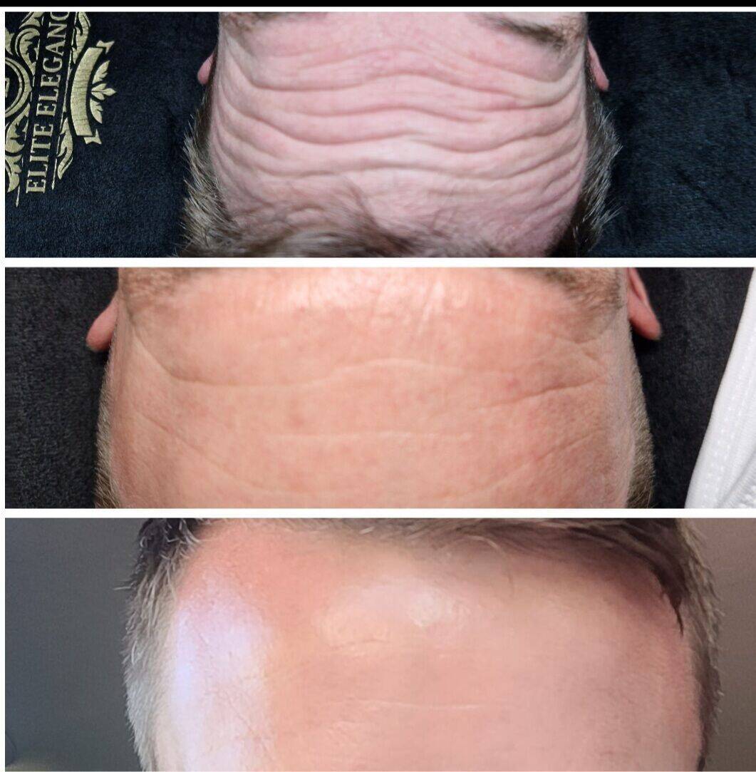 Brotox! Antiwrinkle is popular for men too!