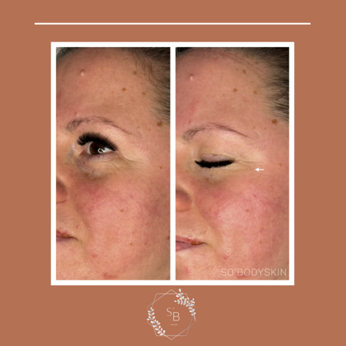 Soin Expert anti-âge - Résultat en 1 séance