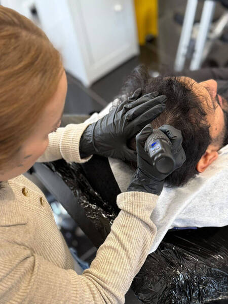 SMP Treatment -Adding density to hair transplant 