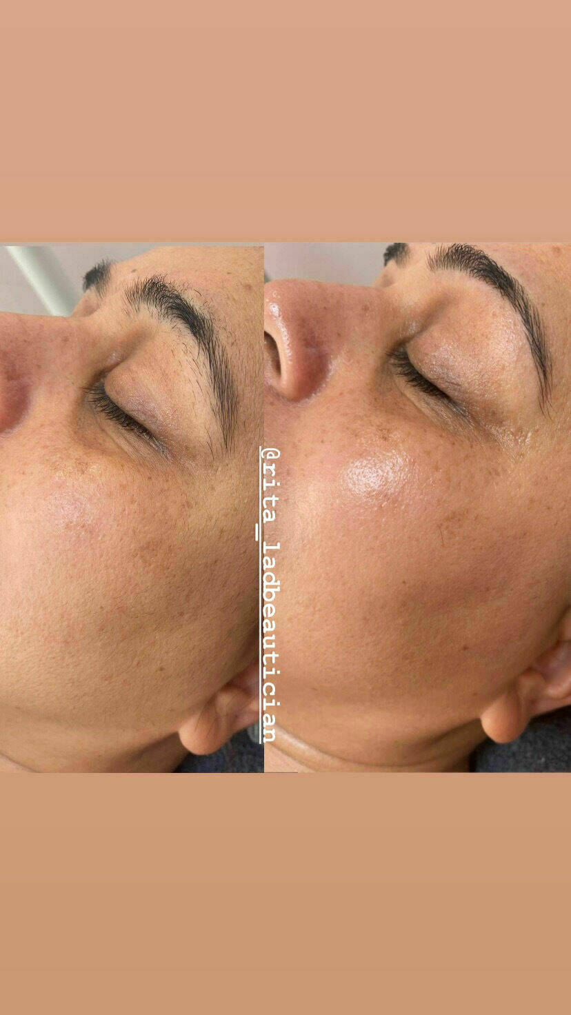 Dermaplane facial before and after 