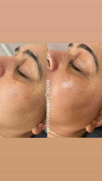 Dermaplane facial before and after 