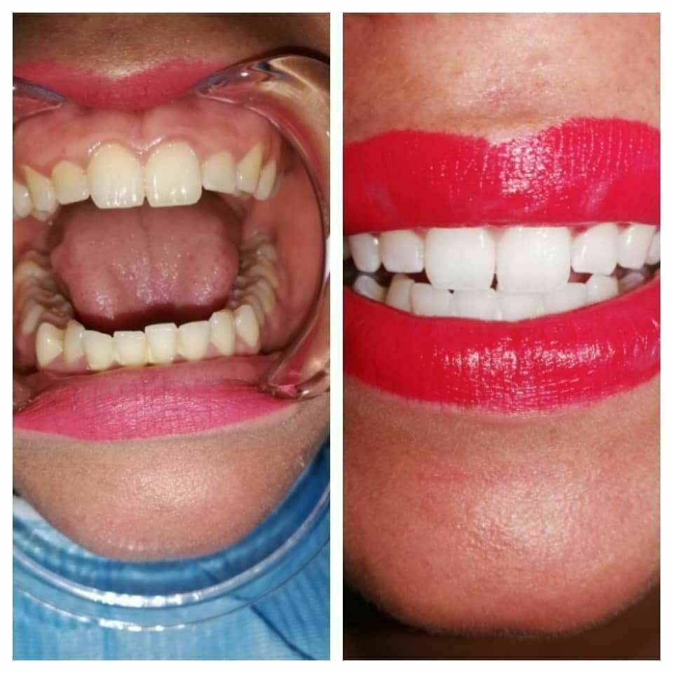 Blanchiment dentaire 