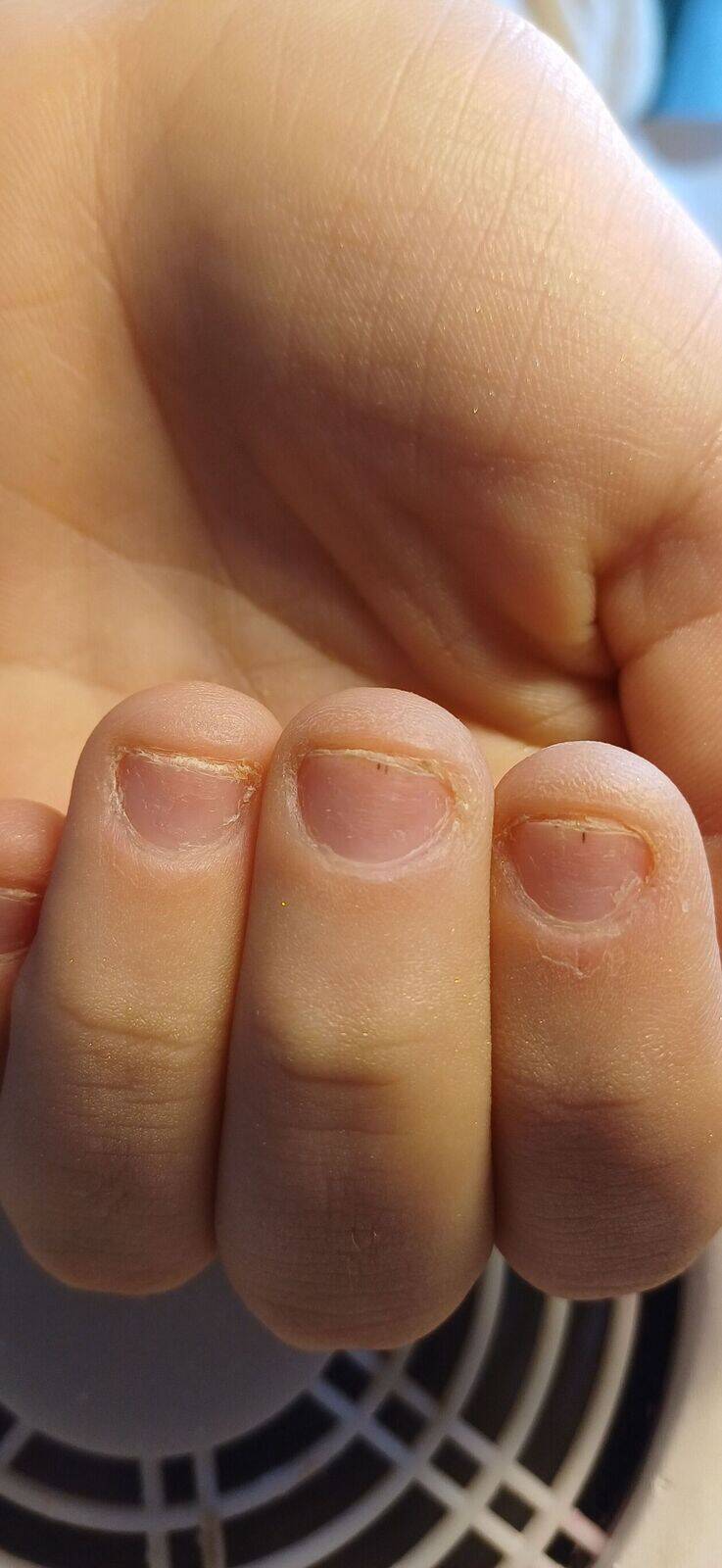 Pose capsule americaine 