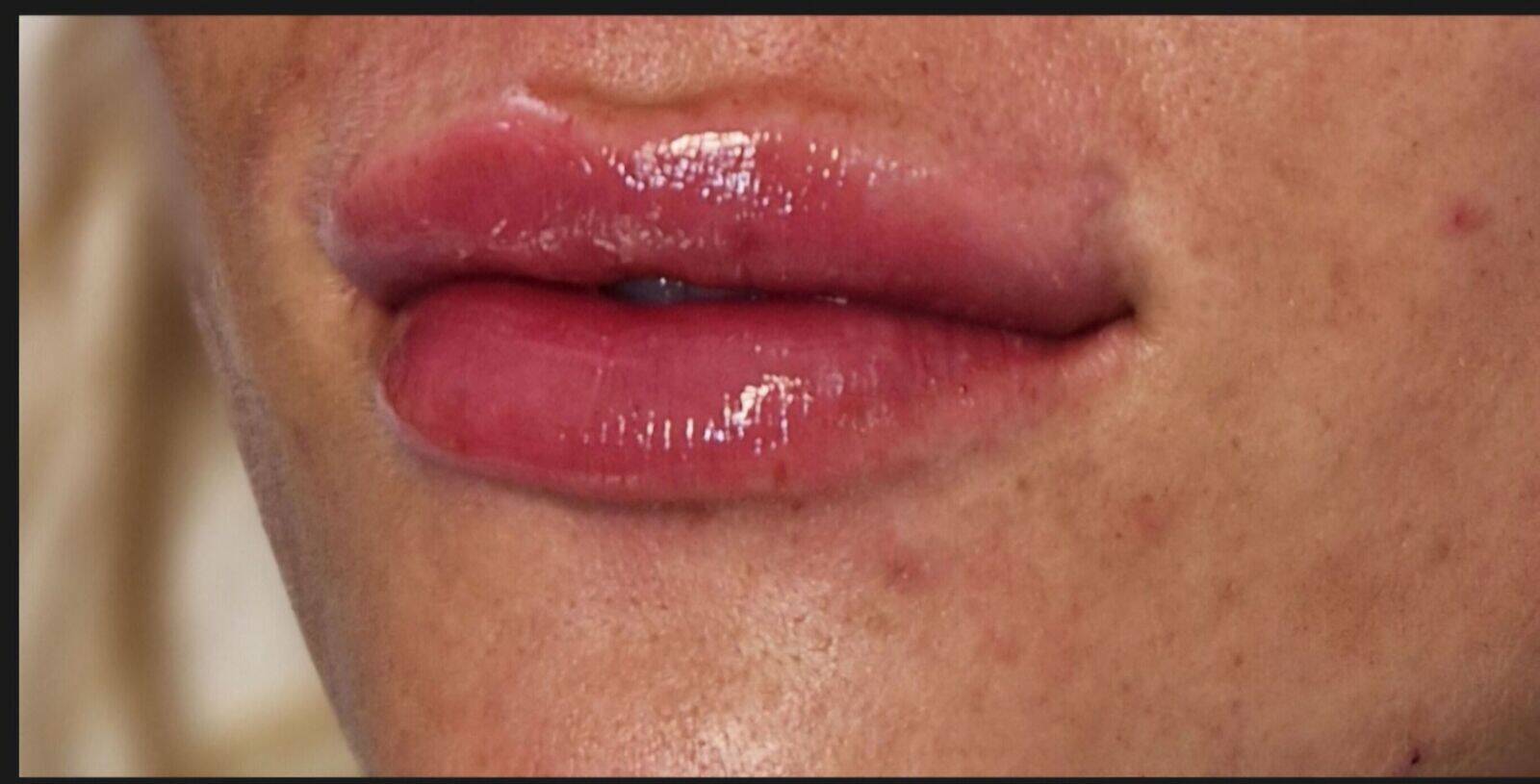 Lip filler 