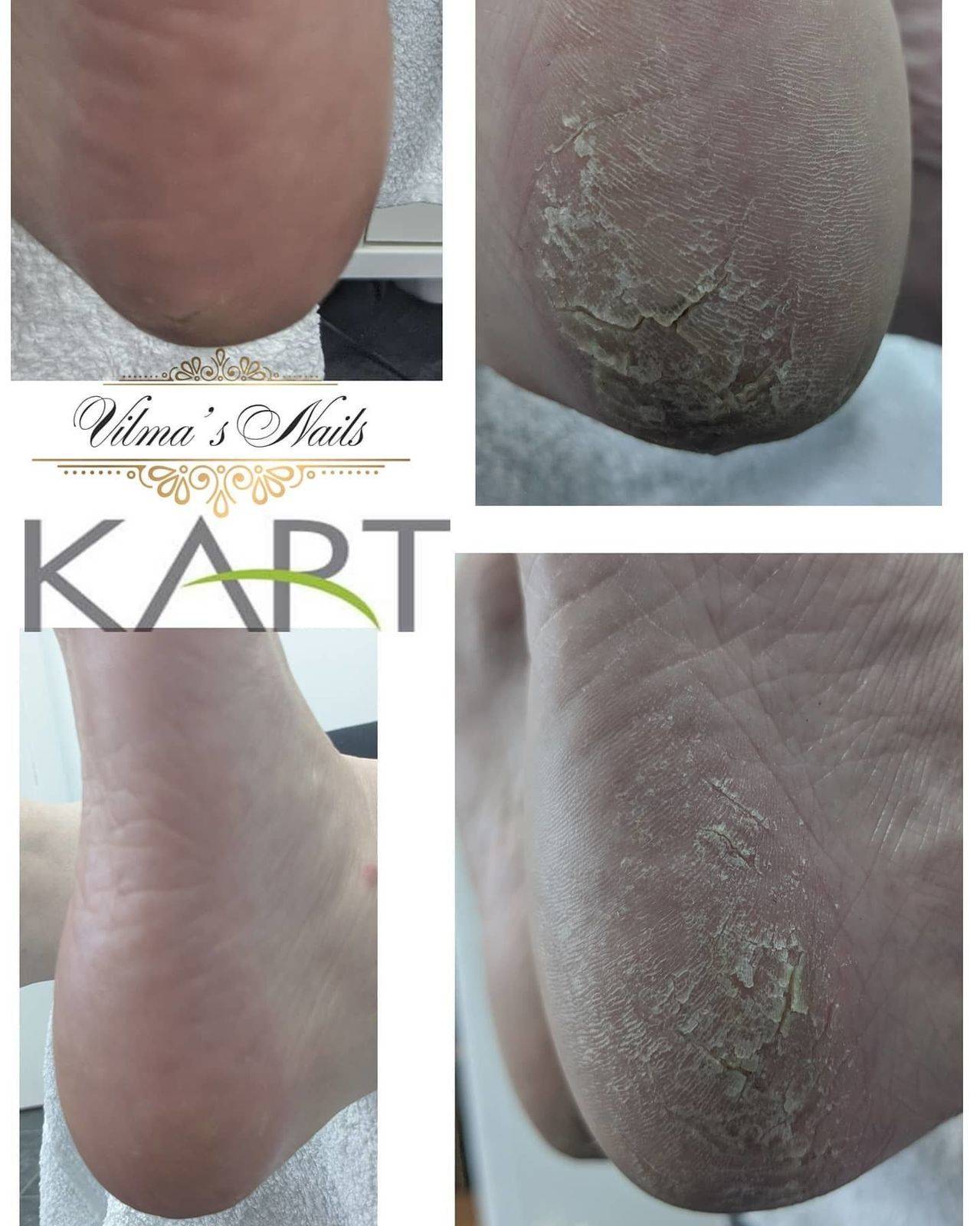 1st KART PEDICURE Treatment