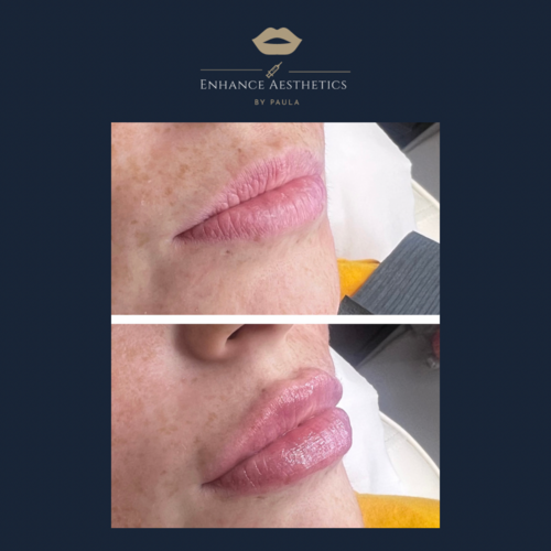 Lip Augmentation 1ml