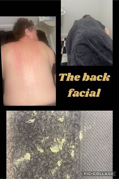 The Bacial aka back facial 