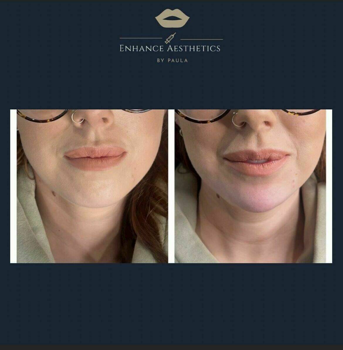 Chin filler for facial profile balancing 1ml before and after