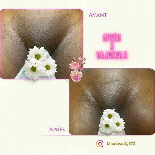 Avant/après incroyable suite à 3 séances de soin Vajacial (soin du pubis)