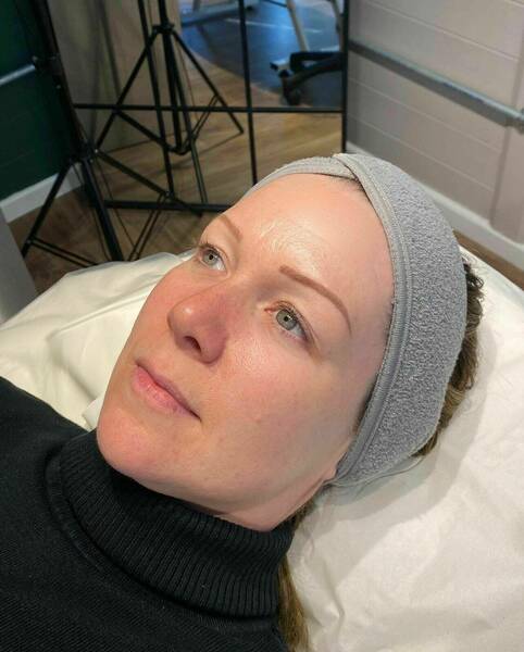 BioRePeel treatment, it is recommended to have 4 treatments, to maximise results. 