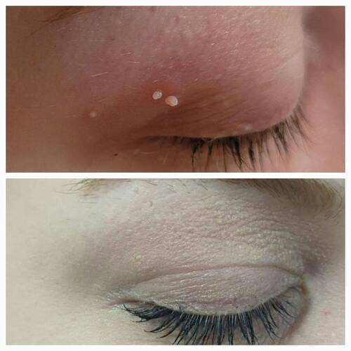 2 skin tags & 1 milia - Before & After Cryo