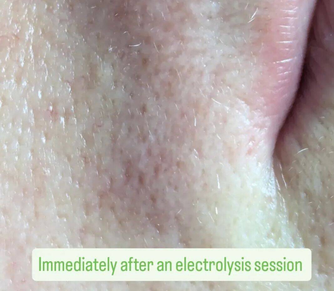 Electrolysis - Top Lip - After