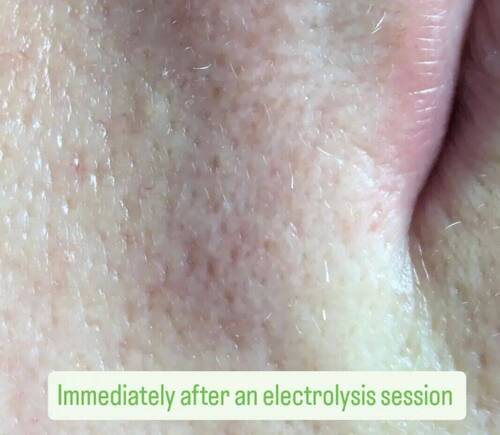 Electrolysis - Top Lip - After