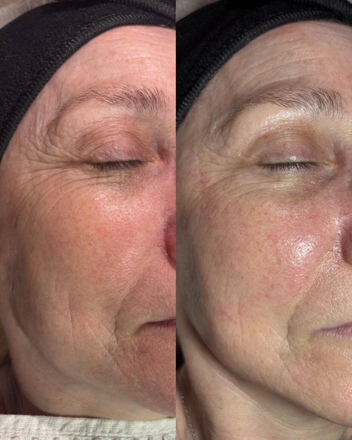 Résultat Soin anti âge 