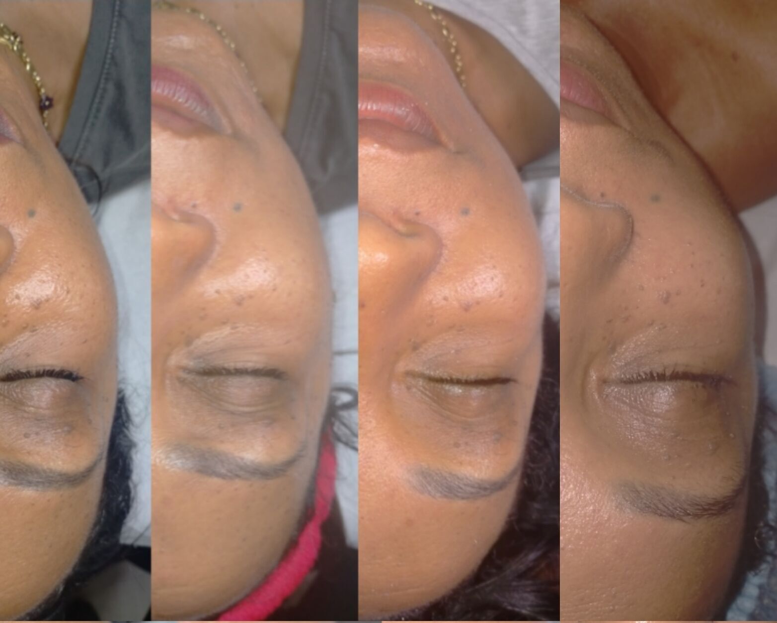 Facialift 4 séances