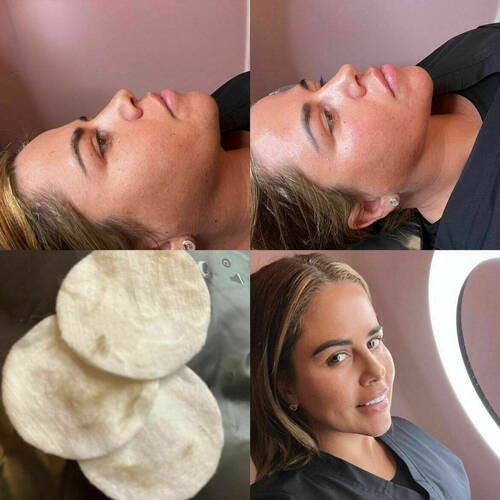 Dermaplaning Facial