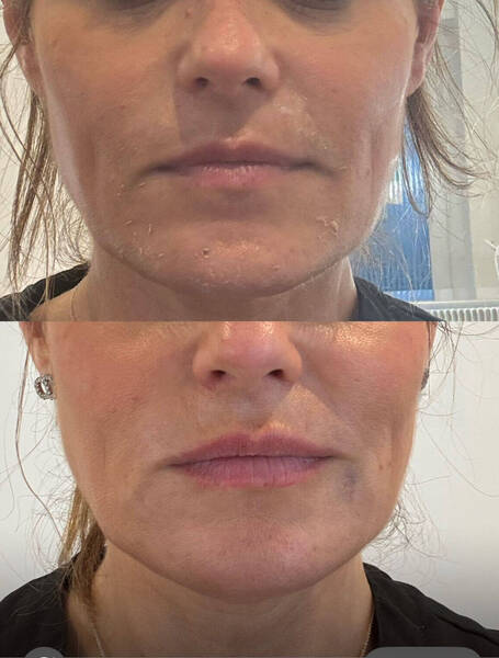 Lower face rejuvenation using dermal fillers