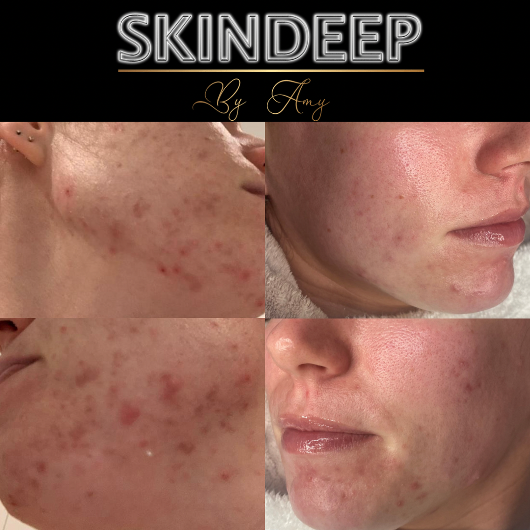 Treating acne prone skin with High Frequency & Chemical peels