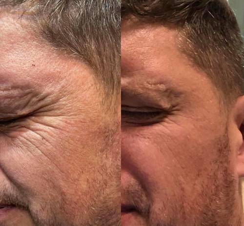 Anti Wrinkle Treatment 