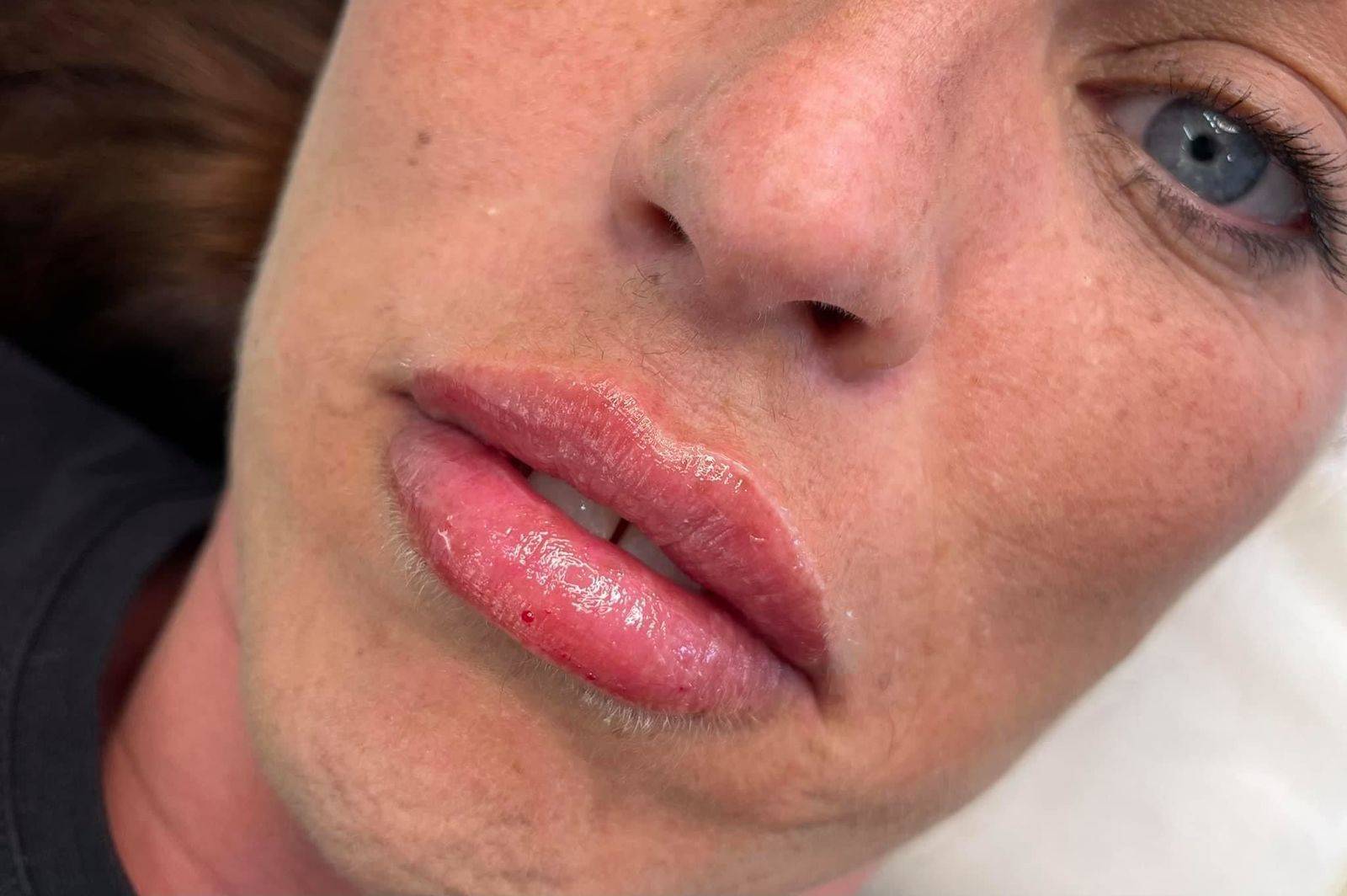 1.1ml Lip Enhancement 