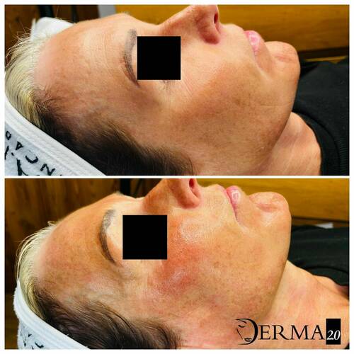 Microneedling with Skin Booster