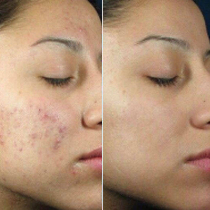 Mesotherapy - Acne Scarring (Block of 6)