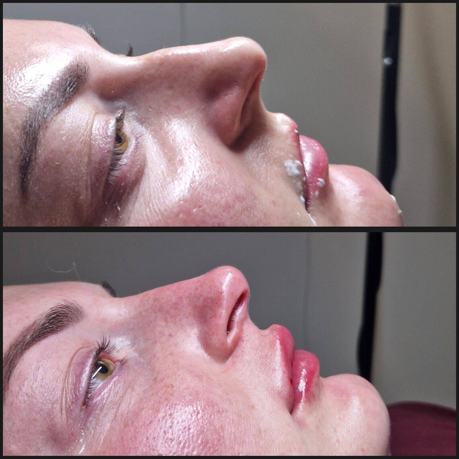 Non-surgical Rhinoplasty and lip filler
