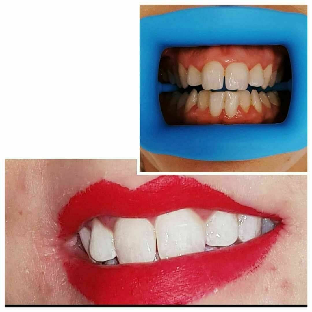 Blanchiment dentaire 