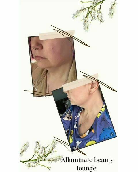 Lemon bottle fat dissolve 